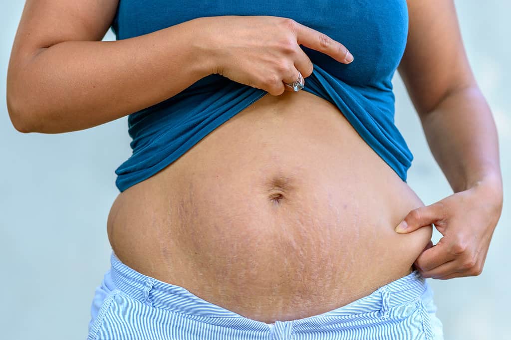 Bauch nach der Schwangerschaft